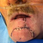 Lower lip reconstruction from skin cancer removal with local Advancement flaps - Man - Case 19208 - Intraoperative - Frontal view