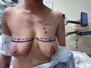 Top Surgery: Double incision mastectomy with free nipple grafting - Female to male - FTM - Masculinizing surgery - Case 21011 - Preoperative - Frontal view