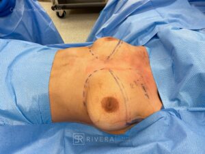 Top Surgery: Double incision mastectomy with free nipple grafting - Female to male - FTM - Masculinizing surgery - Case 21011 - Preoperative - Oblique view