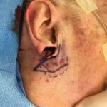 Right earlobe reconstruction from skin cancer removal with cheek flap (2 stages) - Man - Case 17303 - Postoperative - Lateral view