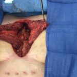 Chest wound reconstruction with pectoralis major flaps - Woman - Case 8902 - Intraoperative - Frontal view