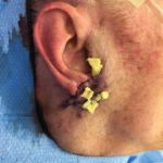 Right earlobe reconstruction from skin cancer removal with cheek flap (2 stages) - Man - Case 17303 - Postoperative - Lateral view