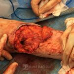 Right antecubital fossa reconstruction (contracture from burn injury) with ALT free flap (the patient could not straighten the arm prior to surgery) - Woman - Case 8901 - Intraoperative - Lateral view