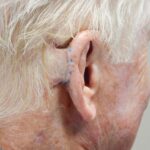Right posterior ear reconstruction from skin cancer removal with Post Auricular flap (2 stages) - Man - Case 17304 - Postoperative - Posterior view