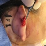 Right ear reconstruction (helix) from skin cancer removal with Post Auricular flap (2 stages) - Woman - Case 17305 - Intraoperative - Lateral view