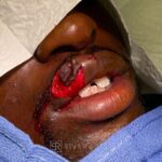 Upper lip reconstruction from traumatic injury with lip graft - Man - Case 19205 - Intraoperative - Oblique view