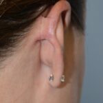 Right ear reconstruction (helix) from skin cancer removal with Post Auricular flap (2 stages) - Woman - Case 17305 - Postoperative - Posterior view