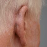 Right posterior ear reconstruction from skin cancer removal with Post Auricular flap (2 stages) - Man - Case 17304 - Postoperative - Posterior view