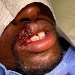 Upper lip reconstruction from traumatic injury with lip graft - Man - Case 19205 - Intraoperative - Oblique view