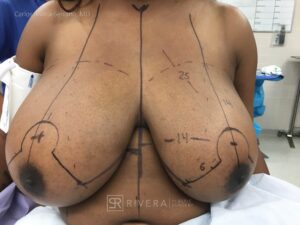Bilateral reduction mammaplasty superomedial dermoglandular pedicle, Wise skin pattern approach (inverted T) - Woman - Case 23019 - Preoperative - Frontal view