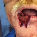 Lower lip reconstruction from skin cancer removal with local Advancement flaps - Man - Case 19204 - Intraoperative- Frontal view