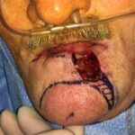 Lower lip reconstruction from skin cancer removal with local Advancement flaps - Man - Case 19208 - Intraoperative - Frontal view