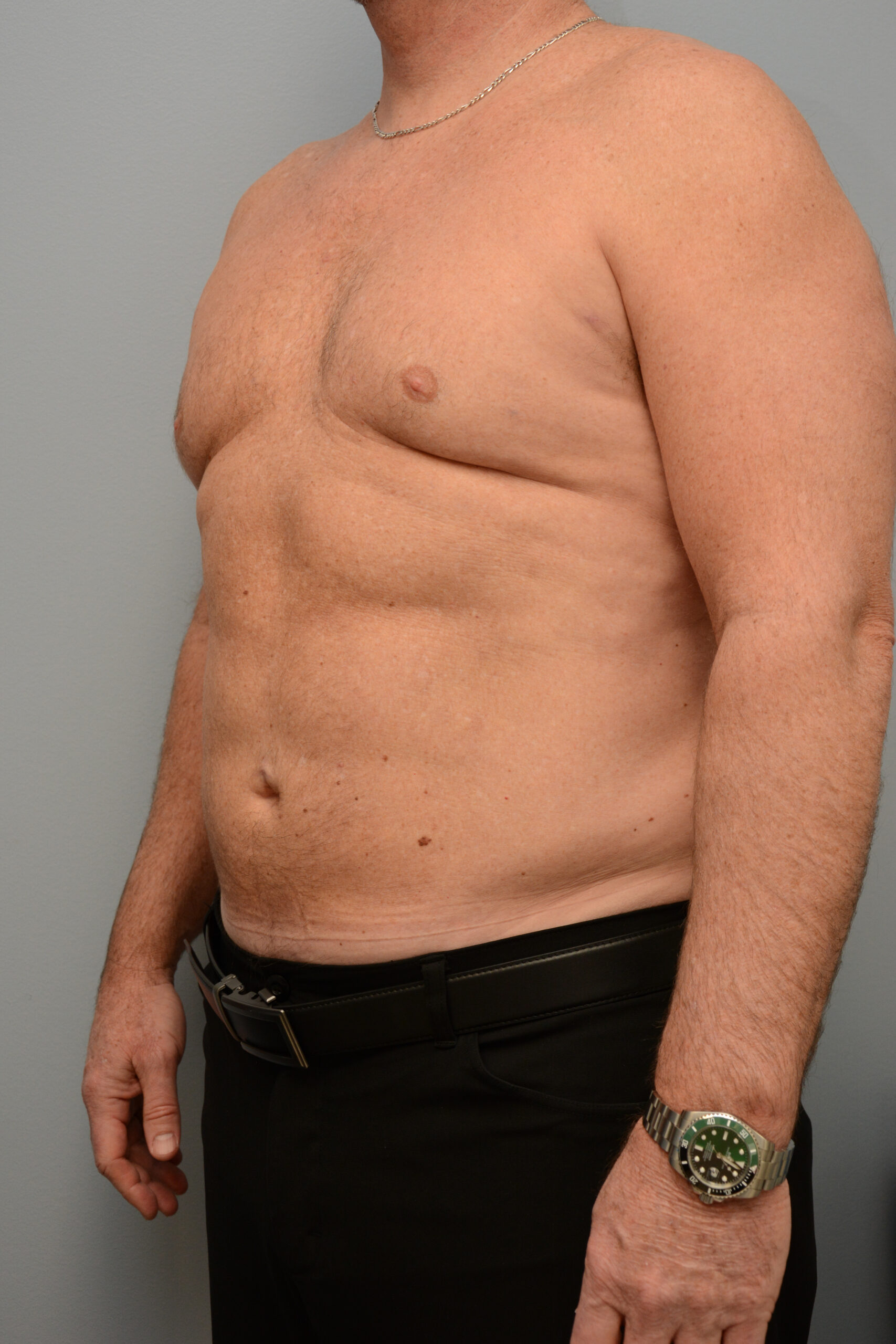 HD Liposuction Men Before and After