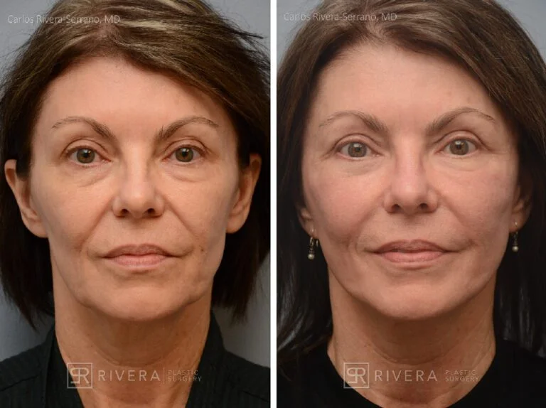 Real patient facelift before and after photo - patient 4763