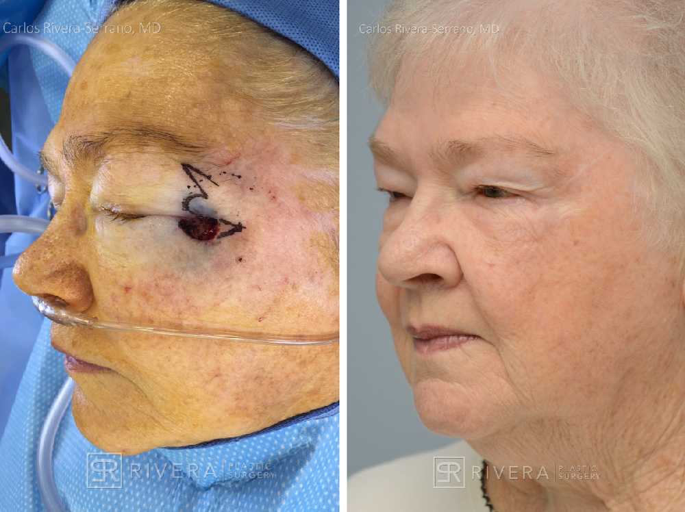 bilobedflaps-case7-dr-carlos-rivera-serrano